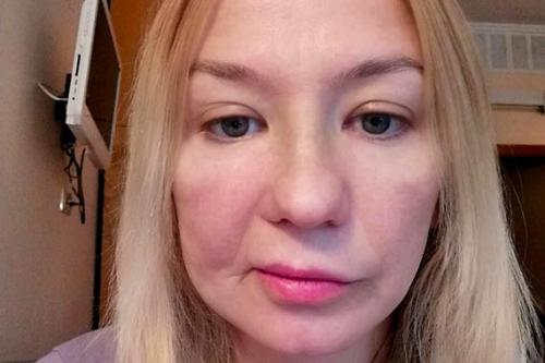 Смотря в зеркало. Сбор завершен. Мария обретет эндопротез и свое лицо. Спасибо вам, друзья!